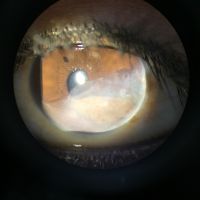 Iris melanoma is the most common primary neoplasm of the iris and accounts for approximately 5% of all uveal melanomas.