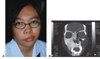 Fibrous dysplasia. A, Facial asymmetry. B, CT scan shows characteristic hyperostosis of involved facial bones.