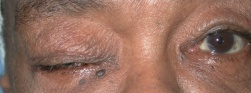 Amyloidosis ptosis .jpg