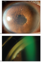 Examples of biopsy-proven sarcoidosis. a. A 47-year-old woman with biopsy-proven sarcoidosis with chronic iridocyclitis. Note the large Koeppe nodules on the iris margin and gelatinous Busacca nodules (most notably in the midperipheral iris stroma at 12 o’clock). b. A 62-year-old woman with biopsy-proven pulmonary sarcoidosis and granulomatous anterior uveitis with Berlin’s nodule in the angle seen on gonioscopy.