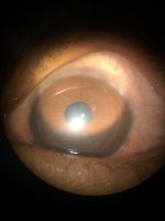 Limbal vernal keratoconjunctivitis leading to pseudogerontoxin.