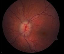 Severe Papilledema grade 3