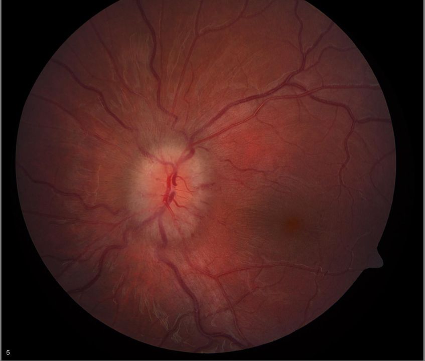 Severe Papilledema