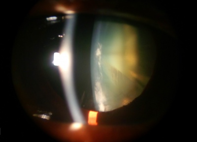 Cortical cataract