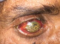 Known as labourer corneal degeneration, characterized by an amber-color corneal deposit or proteinaceous material.