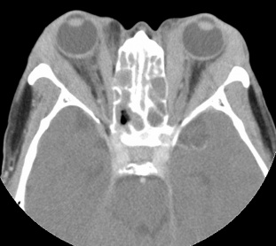 Figure 3: CT image of bilateral medial and lateral rectus tubular-like enlargement with tendon involvement. Courtesy of Z.X. Ding