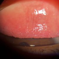 Papillary reaction of bulbar conjunctiva. Conjunctival papillae are most commonly found on bulbar conjunctiva, have a vascular core and are a sign of inflammation.