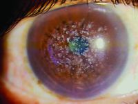 Granular corneal dystrophy.