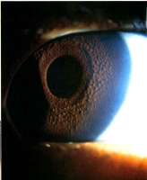 Slit-lamp photograph of left eye of case 7 demonstrates diffuse iris nodules which are more prominent ipsilateral to her oculodermal changes.