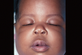 Figure 6. 6-month-old female with severe bilateral blepharoptosis before and after frontalis sling surgery. Photo courtesy of Rona Z. Silkiss, MD, FACS