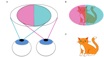 Figure 2. A) Visual field of both eyes with bitemporal hemianopia (left eye visual field indicated in blue, right eye visual field indicated in pink) B) Intact visual fields of an object (cat) at the point of fixation C) Image seen by the patient with binocular vision. The impaired nasal field of each eye is compensated for by the intact temporal field of the other eye.