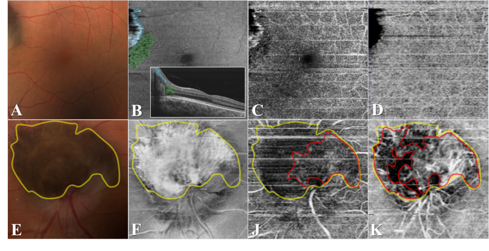 Optic Disk Melanocytoma And Optical Coherence Tomography Angiography Oct A Eyewiki 4338