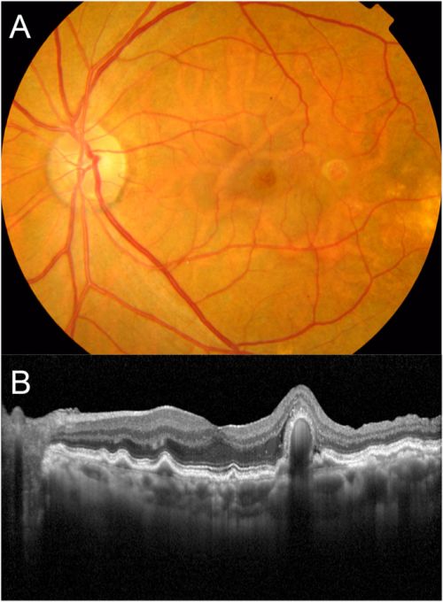 Choroidal Macroaneurysm and Choroidal Macrovessels