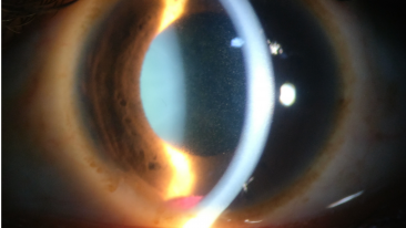 Traumatic uveitis and Hyphema can lead to Synchysis Scintillans