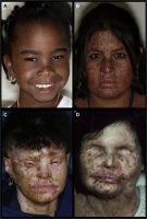 Facial lentigines and ocular abnormalities in patients of different ethnicities who have xeroderma pigmentosum (XP). A, Case 1 is a 5-year-old African American XP-C patient (XP444BE) with lentigines on her skin. B, Case 2 is a 13-year-old First Nations XP-C patient (XP83BE) with many lentigines, ocular surface injection, and sunburn. C, Case 3 is a 39-year-old Hispanic XP-C patient (XP131BE) who is originally from the Dominican Republic. The patient has a history of skin cancer but no history of eyelid or ocular surface cancer. Many prominent lentigines are seen on her face and neck. The patient was fairly darkly pigmented when younger, but now pigmentation has been lost, resulting in hypopigmented areas. D, Case 4 is a 46-year-old Caucasian XP-C patient (XP1BE). 33–35 She underwent bilateral orbital exenteration at ages 32 and 36 years because of recurring invasive squamous cell carcinoma of the ocular surfaces and basal cell carcinoma of the lids, including 1 squamous cell carcinoma that occurred on the palpebral conjunctiva of the upper eyelid, a non–sun-exposed area. 36 This patient, originally light-skinned, has many darkly pigmented lentiginous areas on her face. She died of uterine cancer at age 49 years.