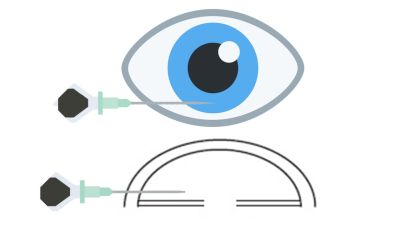 Introduction of a 30-gauge needle attached to a 1 mL tuberculin syringe. The needle is advanced into the anterior chamber through the temporal limbus or clear cornea, parallel to the iris plane, with the tip positioned over the mid-periphery of the iris.