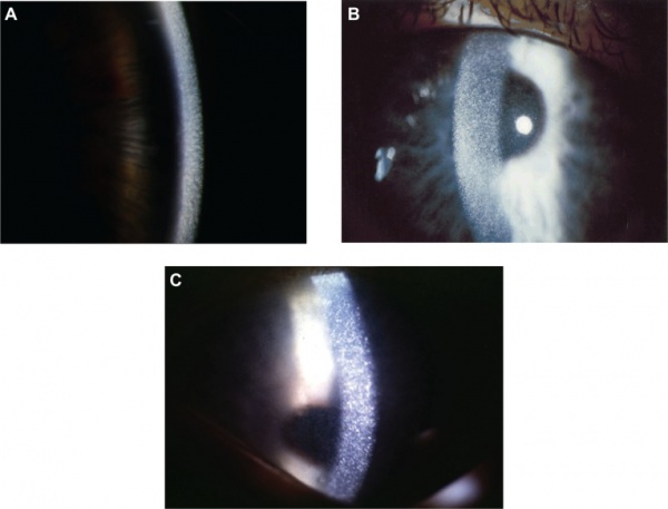 Cystinosis - EyeWiki