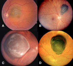 Fig01 eyewiki.jpg