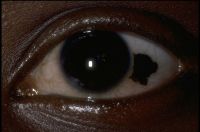 Conjunctival nevi are congenital hamartomas that consist of nests of modified melanocytes (nevus cells).