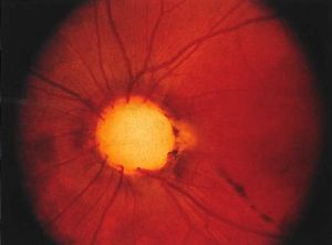 Optic nerve coloboma. Available at AAO.org. Last accessed Sep 5, 2022.