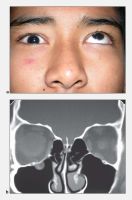 Orbital lymphomat. a. Right inferior rectus entrapment with inability to move the right eye upward past midline. b. Coronal CT scan demonstrating entrapment of the right inferior rectus muscle.