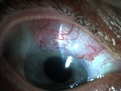 Figure 18B: bleb formation after YAG goniopuncture