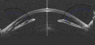 AS-OCT measurement of Angle