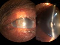 Descematocele. Descement membrane is not disintegrated by the bacterial enzymes and so survives the destructive phase of corneal ulceration.