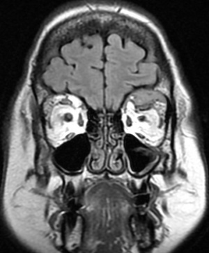 Orbital plasmacytoma MRI .JPG