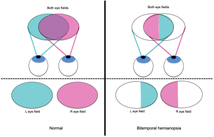 Figure 1. Left: Individual and combined visual fields of left eye (indicated in blue) and right eye (indicated in pink) in a patient with no visual field defects. Area of overlap between the right and left eye visual fields is indicated with purple. Right: Individual and combined visual fields of left eye (indicated in blue) and right eye (indicated in pink) in a patient with bitemporal hemianopia. Note the lack of overlap between the right and left eye visual fields.