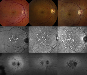 Disease spectrum in pentosan polysulfate maculopathy shown via color fundus photography (top row), near infrared reflectance imaging (middle row), and fundus autofluorescent imaging (bottom row). Severity of cases increases going from left to right