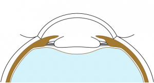 Anterior capsulorhexis.png