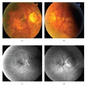 MTM fundus.jpg