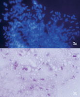 Pathology slide, microsporidial Keratoconjunctivitis scrapings