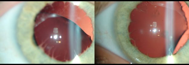 Figure 1. Slit lamp examination of a patient with ELeP and pathogenic ADAMTSL4 variants