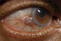 Squamous cell tumor of conjunctiva