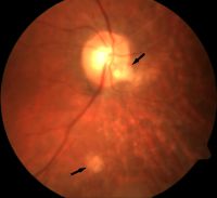 A 69-year-old woman with posterior uveitis shows optic nerve head and choroidal granuloma