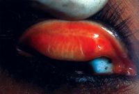 Cicatricial trachoma (TS): presence of scarring in the upper tarsal conjunctiva.