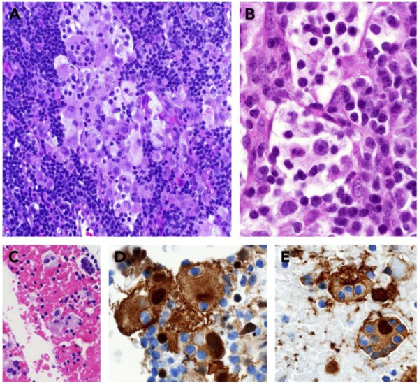 Rosai Dorfman Disease Eyewiki