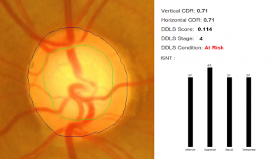 Segmentation of Optic Disc and Cup by Artificial Intelligence