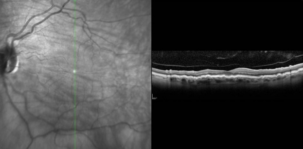 Heidelberg OCT demonstrating chorioretinal fold with vertical scan