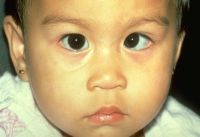 Strabismus. Strabismus is the most common underlying cause of amblyopia. With constant deviation of one eye, reduced vision occurs. Amblyopia is less likely when the deviation is intermittent or when the two eyes alternate fixation.