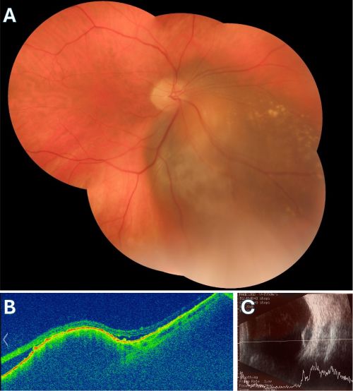 Choroidal Melanoma