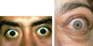 The image on the left shows a patient with bilateral upper eyelid retraction. The image on the right demonstrates lateral flare, a common finding in thyroid eye disease. The eyelid retraction is more pronounced laterally than medially.