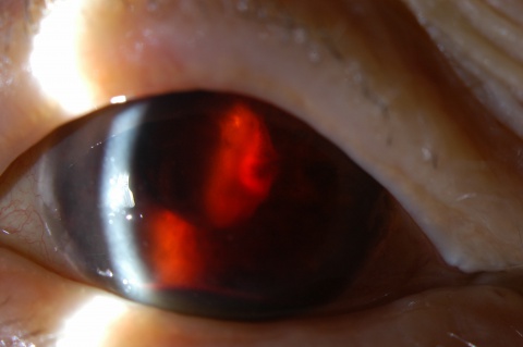 Figure 3. Iris neovascularization in a patient with proliferative diabetic retinopathy with a resultant spontaneous hyphema.