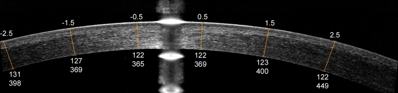 Figure 3. Optical coherence tomography (OCT) image of a LASIK flap showing measurement of the flap and stromal bed thickness. The upper numbers represent the transverse distance from the corneal vertex in millimetres. The lower numbers represent flap thickness and residual stromal bed thickness in microns, respectively.