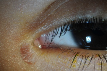 Lacrimal Fistula After.jpg