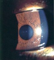 Slit-lamp photograph of right eye of a 2-year-old girl (case 7) with right oculodermal melanocytosis shows multiple small nodules distributed diffusely across the iris surface.