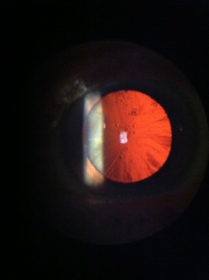 Cortical cataract