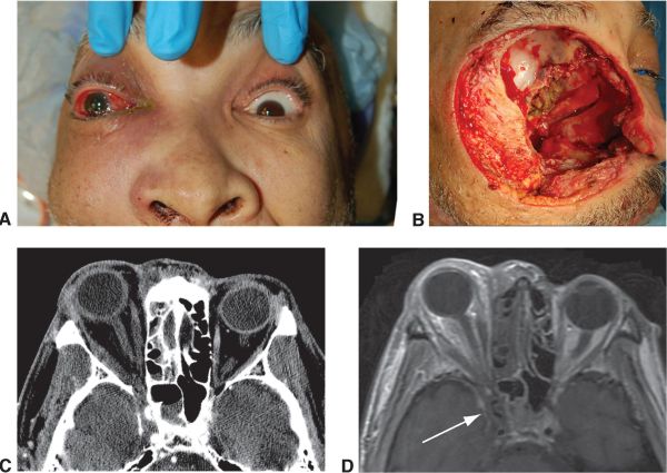 Right-sided sino-orbital zygomycosis in a patient with diabetic ketoacidosis. A, In this photograph, complete right upper eyelid ptosis and ophthalmoplegia are present in the patient. B, Wide surgical debridement consisting of orbital exenteration and sinus surgery was life-saving. CT (C) and MRI (D) axial scans show orbital and sinus involvement as well as cavernous sinus thrombosis (arrow). Courtesy of Bobby S. Korn, MD, PhD, Available at AAO Website, last accessed Aug 15, 2022.